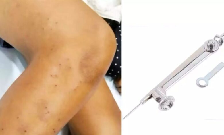 Big News in Indore : हैरान करने वाला मामला…! 4th कक्षा के छात्र पर 3 सहपाठियों ने किया ज्योमेट्री कंपास से 108 बार हमला…पैर हुआ छलनी